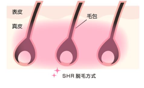 SHR脱毛