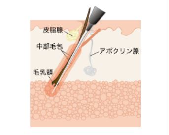 針脱毛