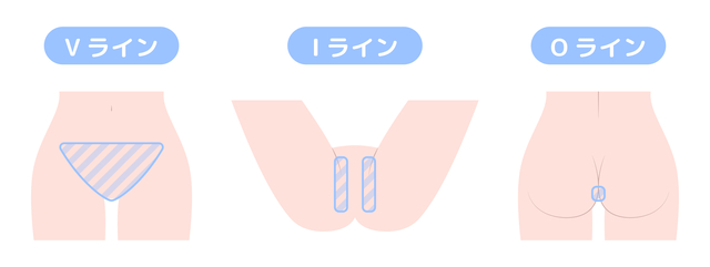 銀座カラーのvio脱毛はいくら 効果はある 料金や痛み 効果が出るまでの回数を解説 ユア脱毛